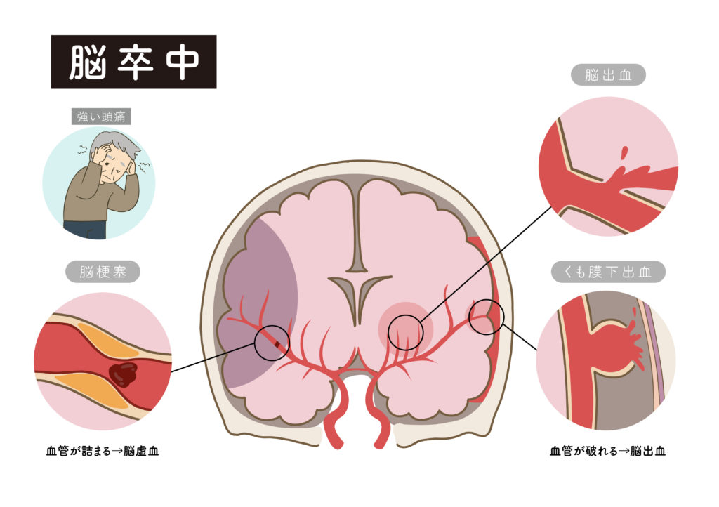 サムネ再作成依頼【理学療法士が解説】脳出血からの回復を目指す人のための基礎知識