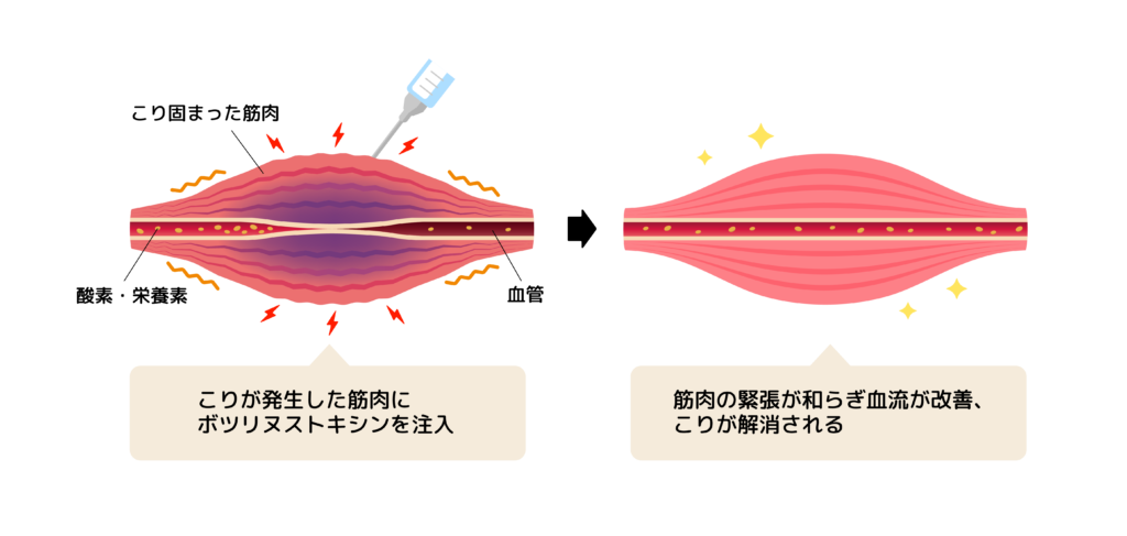 【理学療法士が解説】脳梗塞後の手の麻痺 ~正しい知識とケア~